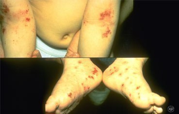 atopic-dermatitis-symptoms_feet.jpg