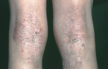 atopic_dermatitis_symptomos_knees.jpg