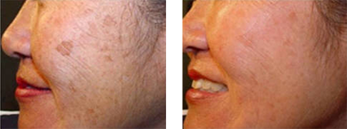 Before and After Intense Pulsed Light Treatment